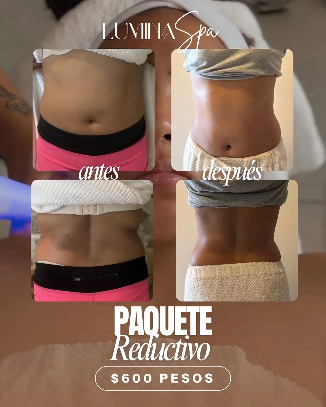 Resultado antes y después de paquete reductivo corporal
